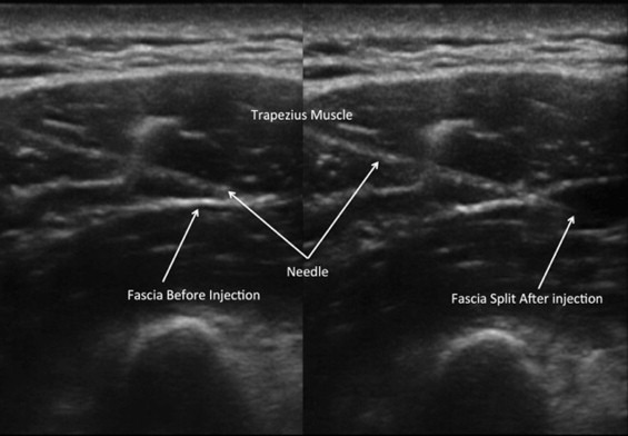 اولتراسوند